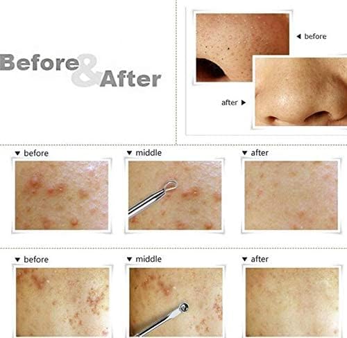 La Perla Tech Stainless Blackhead Comedone Facial Acne Cleaner Double Ends Stainless Steel Pimple & Blackhead Remover Acne Extractor Remover Tool Safety Tool